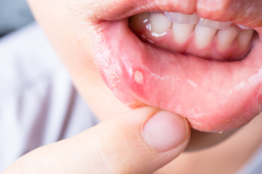 home remedies for mouth ulcer