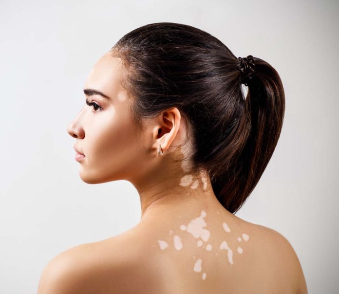 Home Remedies For White Spots
