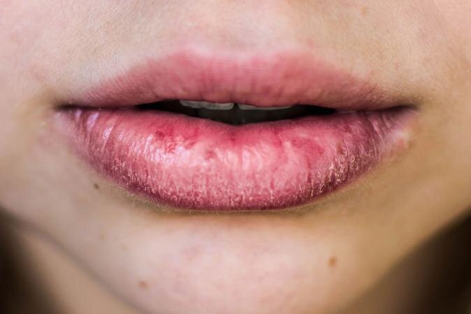 Chapped lips care tips in Marathi