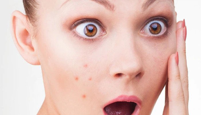 Home Remedies To Remove Face Pimples