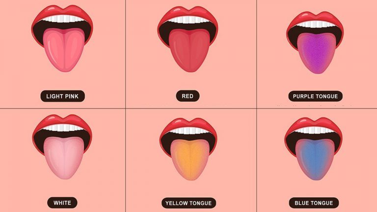Meaning Of Changes In The Color Of Tongue