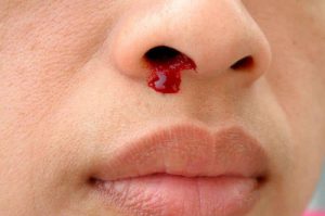 Bleeding From Nose- Home Remedies In Marathi