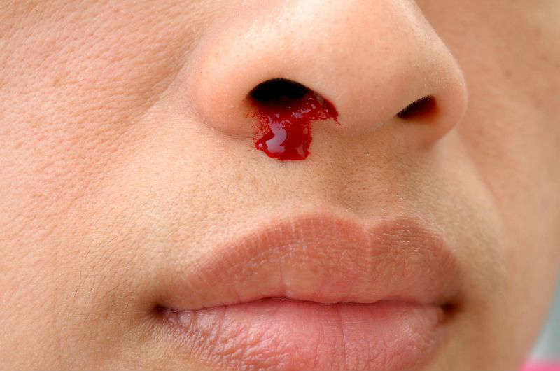 Remedies For Bleeding Nose In Marathi