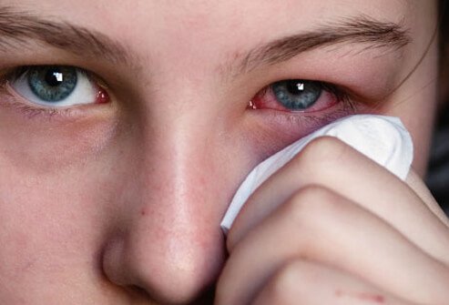 Eyes Allergy And Its Treatment in marathi