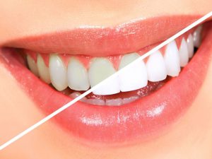 Tips To Whiten Teeth In Marathi